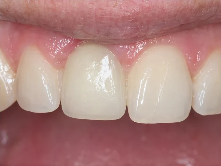 Vue de face : dent antérieure manquante, couronne en DentiFlex, insertion entre les dents adjacentes et résultat