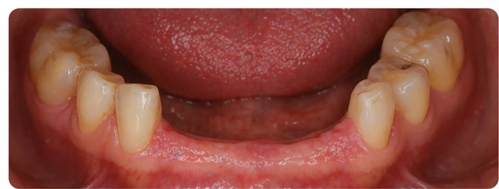 Procédure visuelle pour deux prémolaires et une molaire du haut – principe de mise en place du bridge Denticor avec de nouvelles dents et de son ajustement aux dents adjacentes