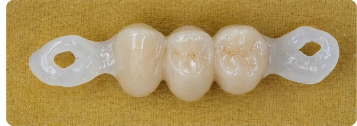 Procédure visuelle pour deux prémolaires et une molaire du haut – principe de mise en place du bridge Denticor avec de nouvelles dents et de son ajustement aux dents adjacentes