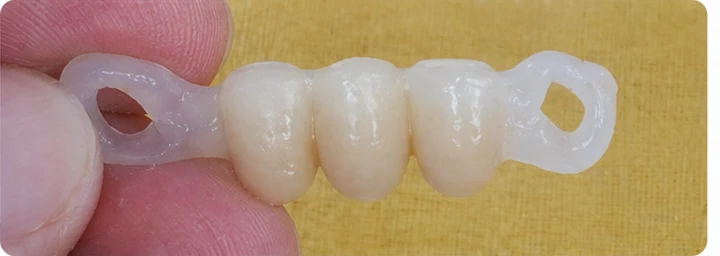 Procédure visuelle pour deux prémolaires et une molaire du haut – principe de mise en place du bridge Denticor avec de nouvelles dents et de son ajustement aux dents adjacentes