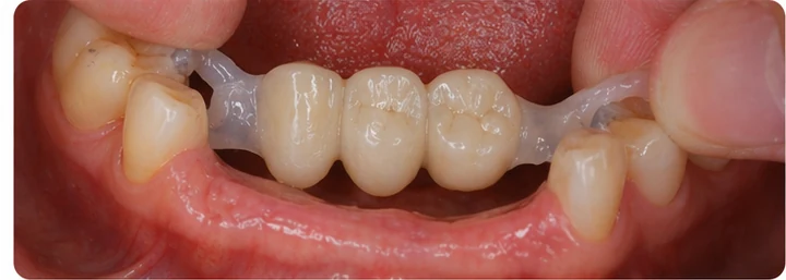 Procédure visuelle pour deux prémolaires et une molaire du haut – principe de mise en place du bridge Denticor avec de nouvelles dents et de son ajustement aux dents adjacentes