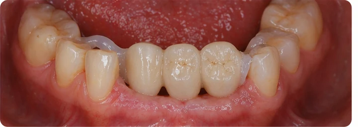 Procédure visuelle pour deux prémolaires et une molaire du haut – principe de mise en place du bridge Denticor avec de nouvelles dents et de son ajustement aux dents adjacentes