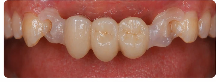 Procédure visuelle pour deux prémolaires et une molaire du haut – principe de mise en place du bridge Denticor avec de nouvelles dents et de son ajustement aux dents adjacentes