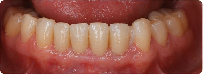 Procédure visuelle pour deux prémolaires et une molaire du haut – principe de mise en place du bridge Denticor avec de nouvelles dents et de son ajustement aux dents adjacentes