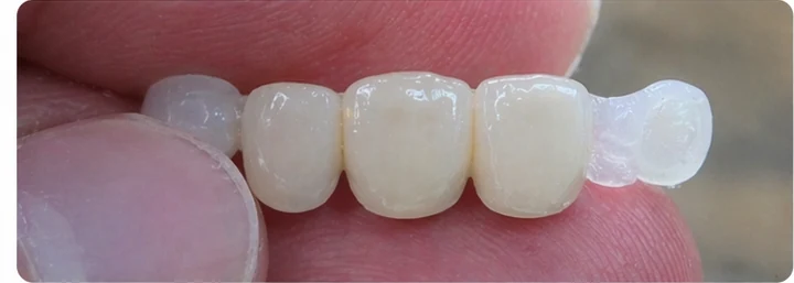 Démonstration de la pose du Denticor : positionnement de la prothèse de remplacement et mise en forme de son support DentiFlex · 3