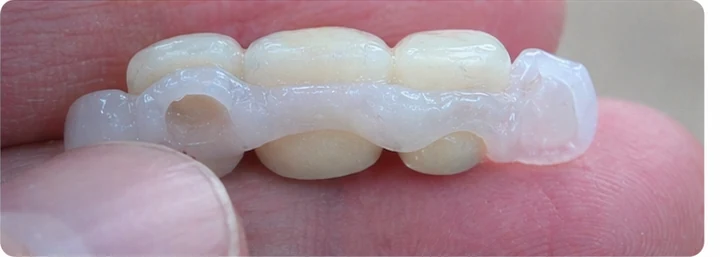 Démonstration de la pose du Denticor : positionnement de la prothèse de remplacement et mise en forme de son support DentiFlex · 4