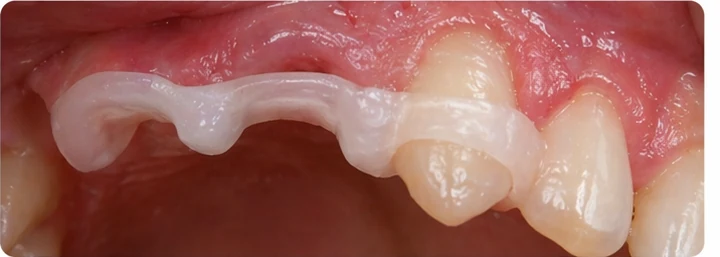 Démonstration de la pose du Denticor : positionnement de la prothèse de remplacement et mise en forme de son support DentiFlex · 6