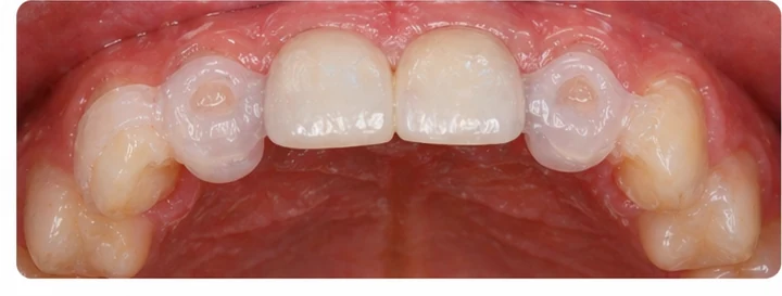Démonstration de la pose du Denticor : positionnement de la prothèse de remplacement et mise en forme de son support DentiFlex · 7