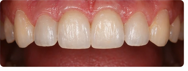Démonstration de la pose du Denticor : positionnement de la prothèse de remplacement et mise en forme de son support DentiFlex · 8