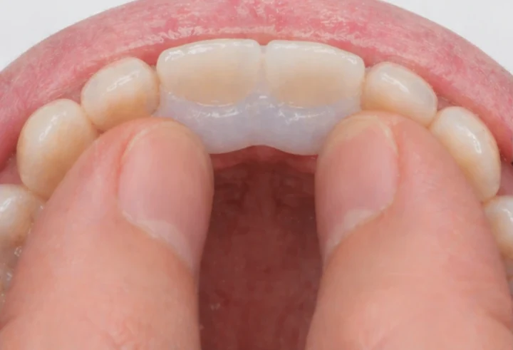 Denticor pour les deux incisives centrales supérieures – vue de l'arrière depuis le palais : forme du bridge et ajustement derrière les nouvelles dents