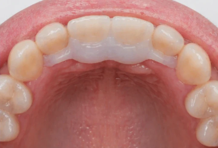 Denticor pour les deux incisives centrales supérieures – vue de l'arrière depuis le palais : forme du bridge et ajustement derrière les nouvelles dents