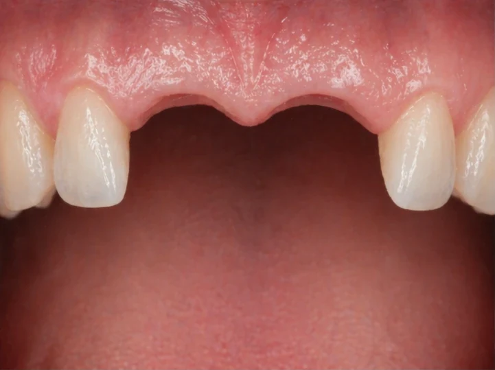 Denticor pour les deux incisives centrales supérieures – vue de face : espace, prothèse préparée, pose et résultat