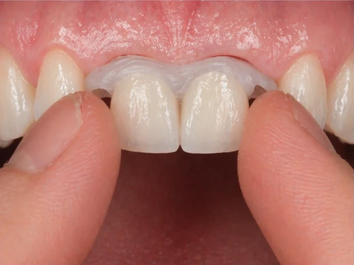 Denticor pour les deux incisives centrales supérieures – vue de face : espace, prothèse préparée, pose et résultat