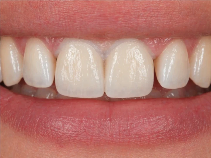 Denticor pour les deux incisives centrales supérieures – vue de face : espace, prothèse préparée, pose et résultat
