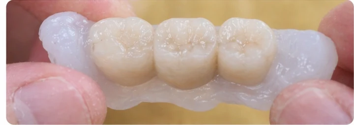 Guide visuel – trois dents supérieures postérieures manquantes