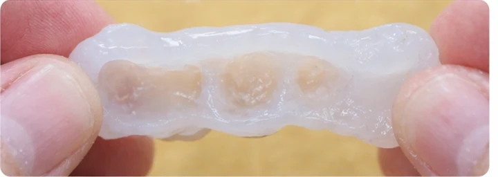 Guide visuel – trois dents supérieures postérieures manquantes