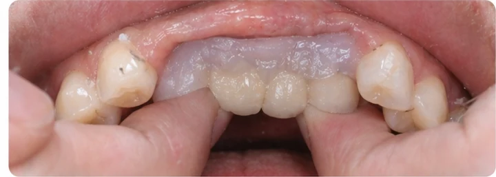 Guide visuel – trois dents supérieures postérieures manquantes