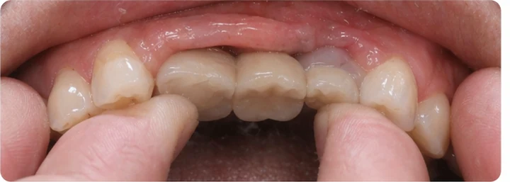 Guide visuel – trois dents supérieures postérieures manquantes