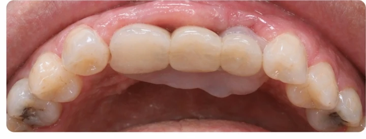 Guide visuel – trois dents supérieures postérieures manquantes