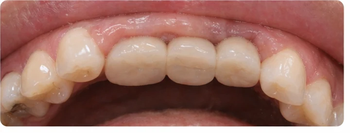 Guide visuel – trois dents supérieures postérieures manquantes