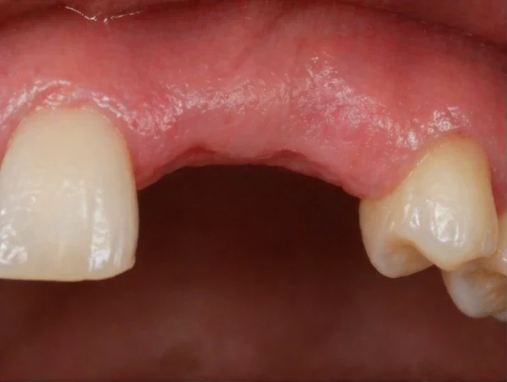 Remplacement Denticor de l’incisive latérale et de la canine supérieures – vue de face, pose du bridge et résultat