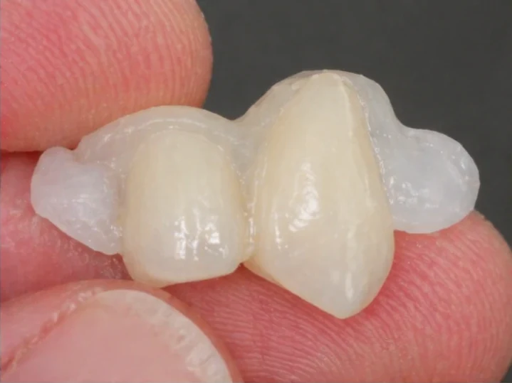 Remplacement Denticor de l’incisive latérale et de la canine supérieures – vue de face, pose du bridge et résultat