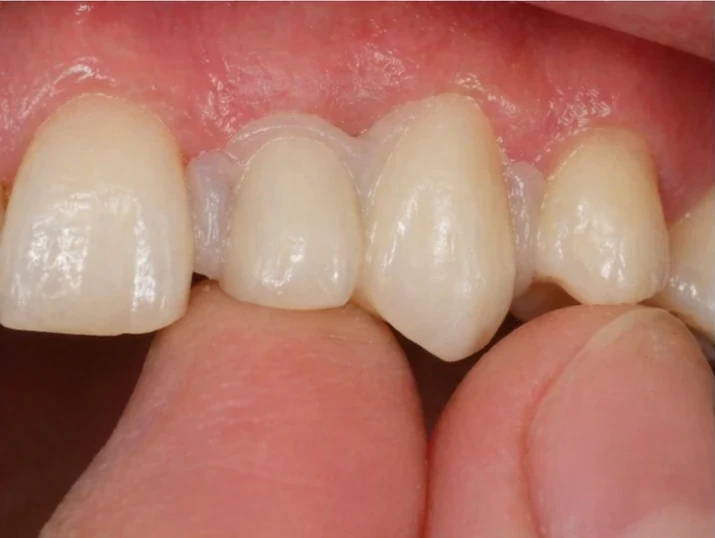 Remplacement Denticor de l’incisive latérale et de la canine supérieures – vue de face, pose du bridge et résultat