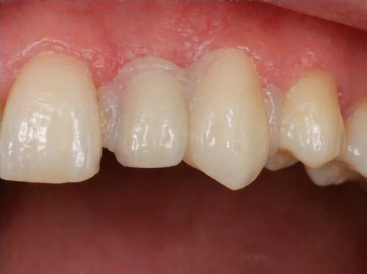 Remplacement Denticor de l’incisive latérale et de la canine supérieures – vue de face, pose du bridge et résultat