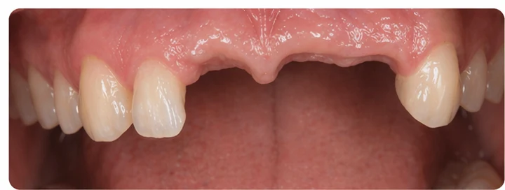 Démonstration de la pose du Denticor : positionnement de la prothèse de remplacement et mise en forme de son support DentiFlex · 1