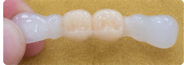 Démonstration de la pose du Denticor : positionnement de la prothèse de remplacement et mise en forme de son support DentiFlex · 3