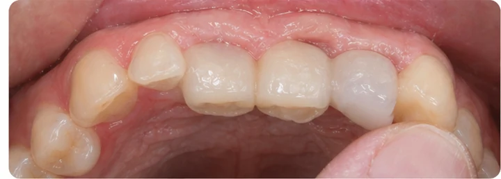 Démonstration de la pose du Denticor : positionnement de la prothèse de remplacement et mise en forme de son support DentiFlex · 5