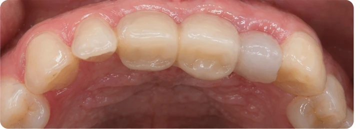 Démonstration de la pose du Denticor : positionnement de la prothèse de remplacement et mise en forme de son support DentiFlex · 6