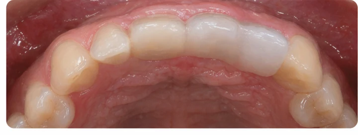 Démonstration de la pose du Denticor : positionnement de la prothèse de remplacement et mise en forme de son support DentiFlex · 7