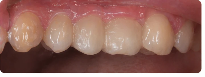 Démonstration de la pose du Denticor : positionnement de la prothèse de remplacement et mise en forme de son support DentiFlex · 8