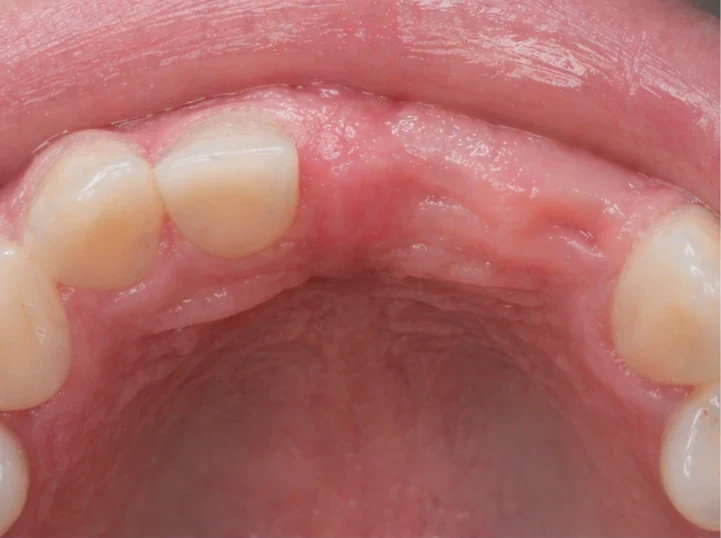 Denticor pour les incisives centrales et latérales supérieures – vue de l’arrière depuis le palais : forme du pont et ajustement derrière les nouvelles dents