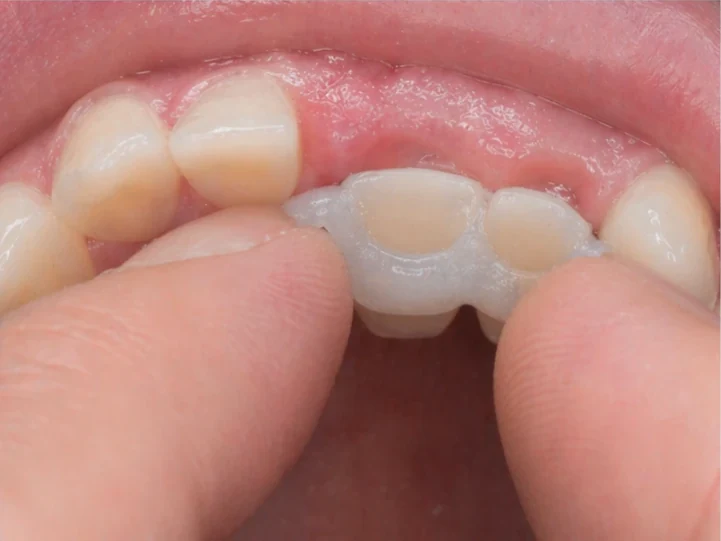 Denticor pour les incisives centrales et latérales supérieures – vue de l’arrière depuis le palais : forme du pont et ajustement derrière les nouvelles dents