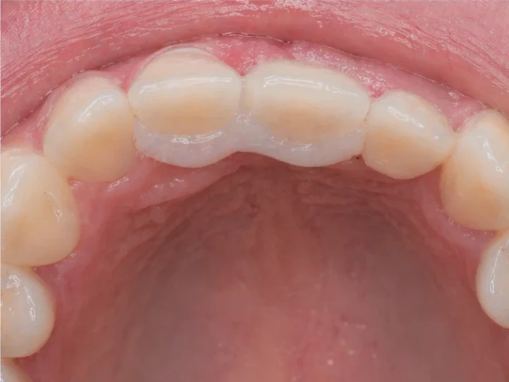 Denticor pour les incisives centrales et latérales supérieures – vue de l’arrière depuis le palais : forme du pont et ajustement derrière les nouvelles dents