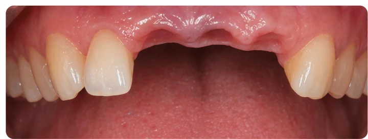 Procédure visuelle pour trois dents adjacentes de l'arcade supérieure – principe de pose d'un bridge Denticor avec de nouvelles dents et de son ajustement aux dents environnantes