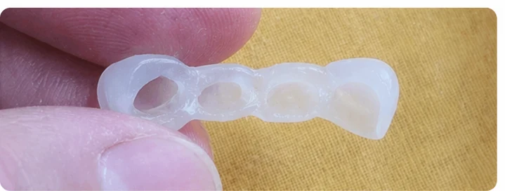 Procédure visuelle pour trois dents adjacentes de l'arcade supérieure – principe de pose d'un bridge Denticor avec de nouvelles dents et de son ajustement aux dents environnantes