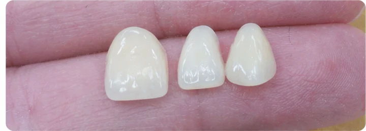 Procédure visuelle pour trois dents adjacentes de l'arcade supérieure – principe de pose d'un bridge Denticor avec de nouvelles dents et de son ajustement aux dents environnantes