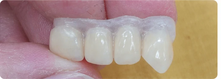 Procédure visuelle pour trois dents adjacentes de l'arcade supérieure – principe de pose d'un bridge Denticor avec de nouvelles dents et de son ajustement aux dents environnantes