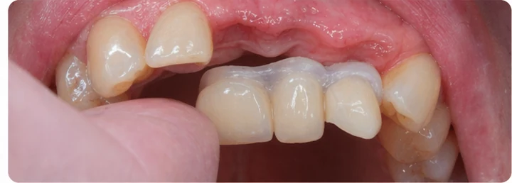 Procédure visuelle pour trois dents adjacentes de l'arcade supérieure – principe de pose d'un bridge Denticor avec de nouvelles dents et de son ajustement aux dents environnantes