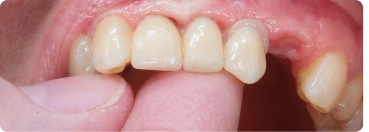 Procédure visuelle pour trois dents adjacentes de l'arcade supérieure – principe de pose d'un bridge Denticor avec de nouvelles dents et de son ajustement aux dents environnantes