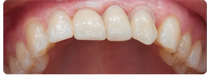 Procédure visuelle pour trois dents adjacentes de l'arcade supérieure – principe de pose d'un bridge Denticor avec de nouvelles dents et de son ajustement aux dents environnantes