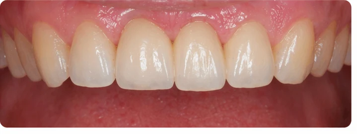 Procédure visuelle pour trois dents adjacentes de l'arcade supérieure – principe de pose d'un bridge Denticor avec de nouvelles dents et de son ajustement aux dents environnantes
