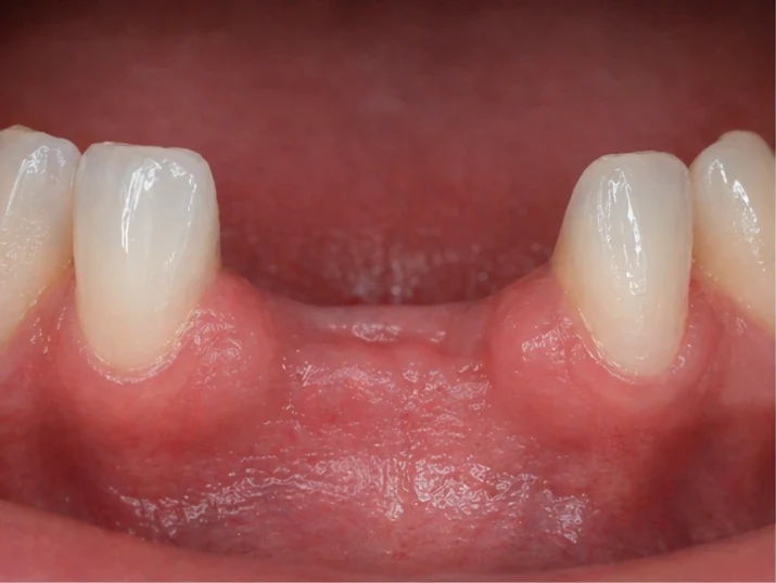 Denticor : remplacement rapide de deux incisives inférieures : espace, bridge DentiFlex prêt à l'emploi avec deux dents, insertion en un seul bloc et résultat