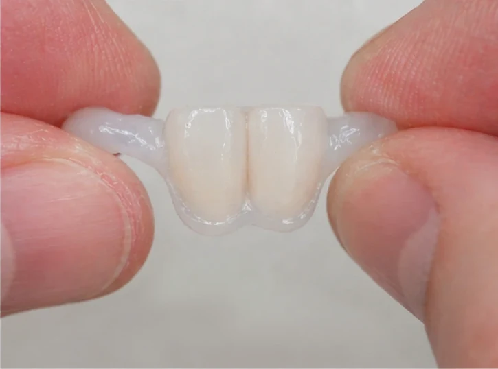 Denticor : remplacement rapide de deux incisives inférieures : espace, bridge DentiFlex prêt à l'emploi avec deux dents, insertion en un seul bloc et résultat