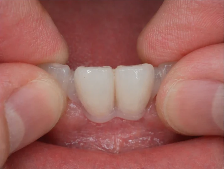 Denticor : remplacement rapide de deux incisives inférieures : espace, bridge DentiFlex prêt à l'emploi avec deux dents, insertion en un seul bloc et résultat