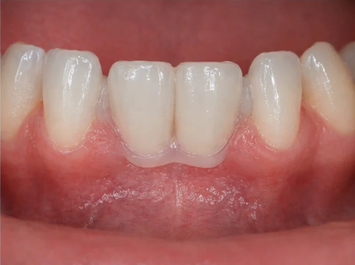 Denticor : remplacement rapide de deux incisives inférieures : espace, bridge DentiFlex prêt à l'emploi avec deux dents, insertion en un seul bloc et résultat