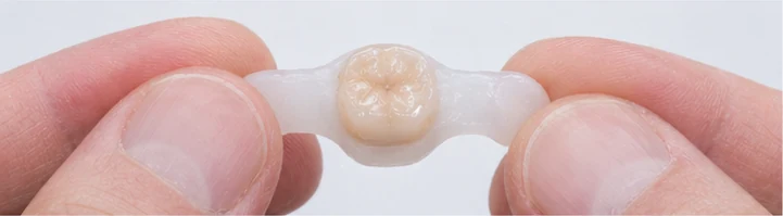 Guide visuel – dent supérieure manquante avec les dents adjacentes